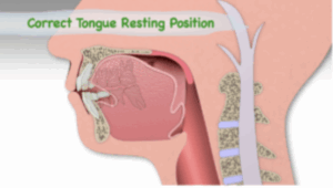 Correct tongue posture