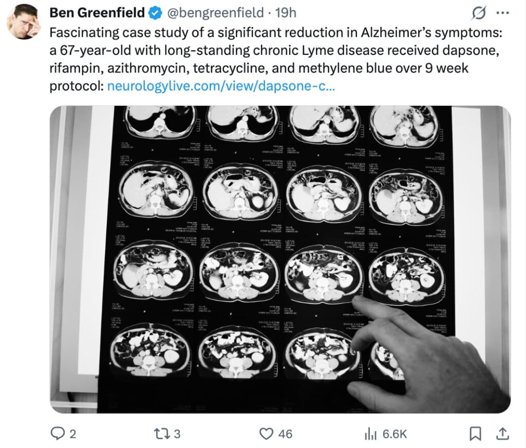 Twitter post from Ben Greenfield (@bengreenfield) describing a case study of reduced Alzheimer's symptoms in a 67-year-old with chronic Lyme disease treated with dapsone, rifampin, azithromycin, tetracycline, and methylene blue over a 9-week protocol, linking to an article on neurologylive.com. The image shows a light box displaying a grid of black-and-white abdominal CT scan slices, with a hand pointing to one of the scans.