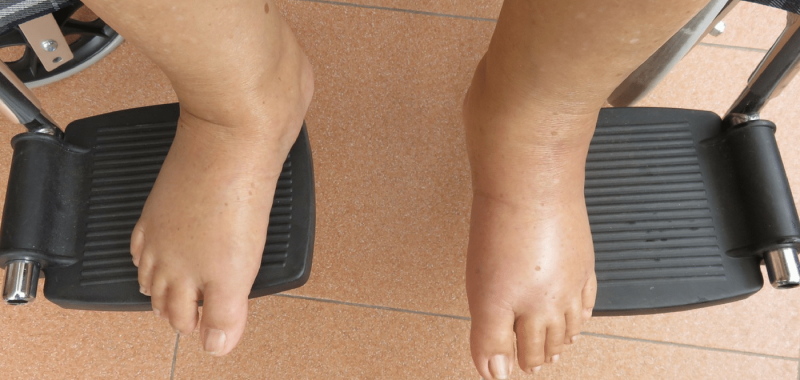 Water Retention and Bloating